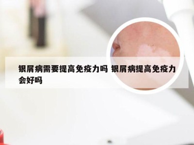 银屑病需要提高免疫力吗 银屑病提高免疫力会好吗