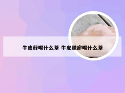 牛皮藓喝什么茶 牛皮肤癣喝什么茶