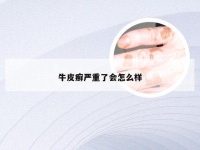 牛皮癣严重了会怎么样