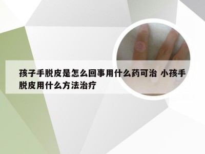 孩子手脱皮是怎么回事用什么药可治 小孩手脱皮用什么方法治疗