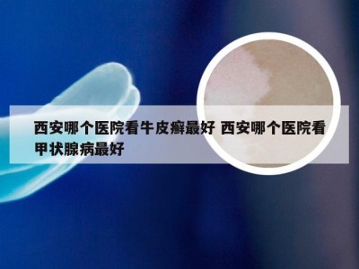 西安哪个医院看牛皮癣最好 西安哪个医院看甲状腺病最好