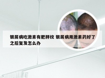 银屑病吃激素有肥胖纹 银屑病用激素药好了之后复发怎么办