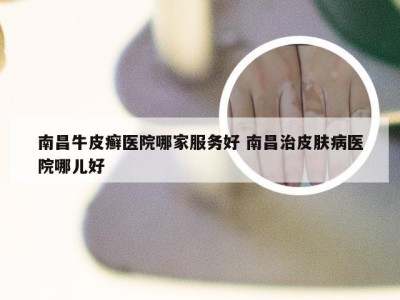 南昌牛皮癣医院哪家服务好 南昌治皮肤病医院哪儿好