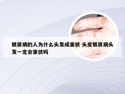 银屑病的人为什么头发成束状 头皮银屑病头发一定会束状吗