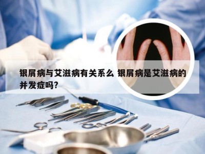 银屑病与艾滋病有关系么 银屑病是艾滋病的并发症吗?