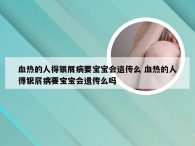 血热的人得银屑病要宝宝会遗传么 血热的人得银屑病要宝宝会遗传么吗