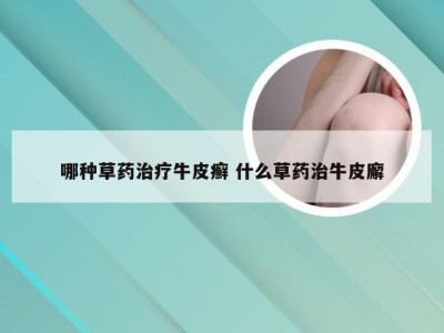 哪种草药治疗牛皮癣 什么草药治牛皮廨