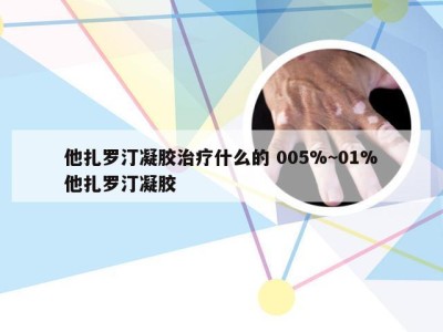 他扎罗汀凝胶治疗什么的 005%~01%他扎罗汀凝胶