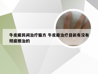 牛皮廨民间治疗偏方 牛皮廨治疗目前有没有彻底根治的