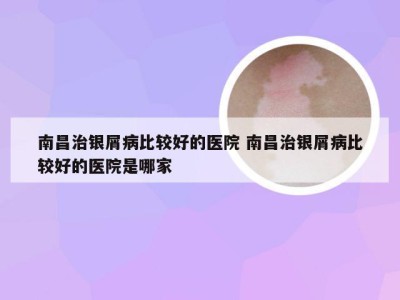 南昌治银屑病比较好的医院 南昌治银屑病比较好的医院是哪家