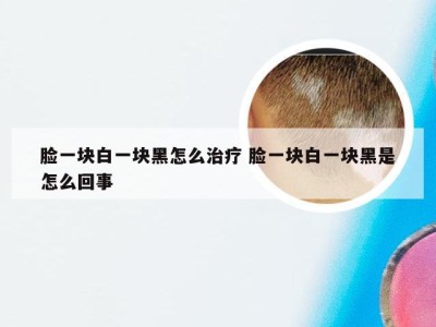 脸一块白一块黑怎么治疗 脸一块白一块黑是怎么回事