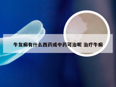 牛友癣有什么西药或中药可治呢 治疗牛癣