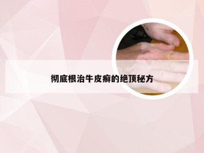 彻底根治牛皮癣的绝顶秘方