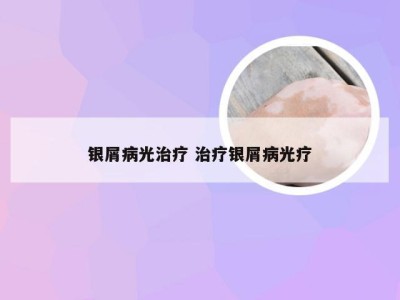 银屑病光治疗 治疗银屑病光疗