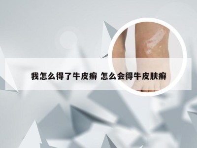 我怎么得了牛皮癣 怎么会得牛皮肤癣