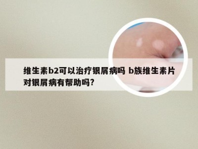 维生素b2可以治疗银屑病吗 b族维生素片对银屑病有帮助吗?