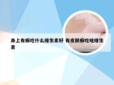 身上有癣吃什么维生素好 有皮肤癣吃啥维生素