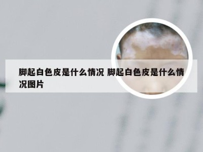 脚起白色皮是什么情况 脚起白色皮是什么情况图片