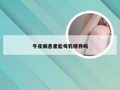 牛皮癣患者能母乳喂养吗