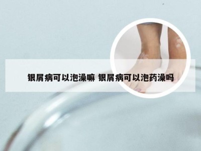 银屑病可以泡澡嘛 银屑病可以泡药澡吗