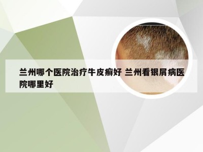 兰州哪个医院治疗牛皮癣好 兰州看银屑病医院哪里好