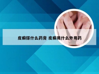 皮癣搽什么药膏 皮癣用什么外用药