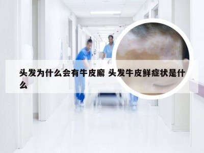 头发为什么会有牛皮廨 头发牛皮鲜症状是什么