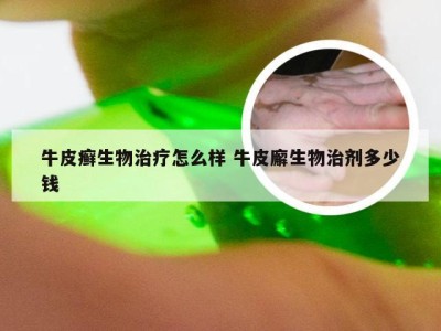 牛皮癣生物治疗怎么样 牛皮廨生物治剂多少钱