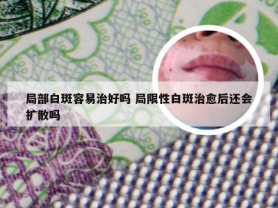 局部白斑容易治好吗 局限性白斑治愈后还会扩散吗