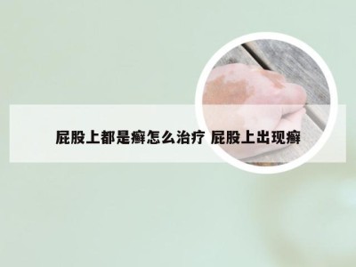 屁股上都是癣怎么治疗 屁股上出现癣