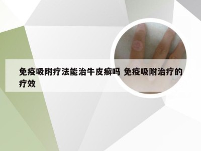 免疫吸附疗法能治牛皮癣吗 免疫吸附治疗的疗效