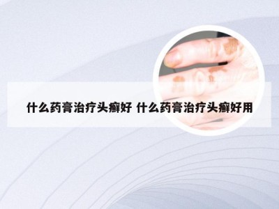 什么药膏治疗头癣好 什么药膏治疗头癣好用