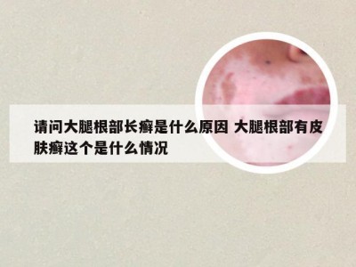 请问大腿根部长癣是什么原因 大腿根部有皮肤癣这个是什么情况