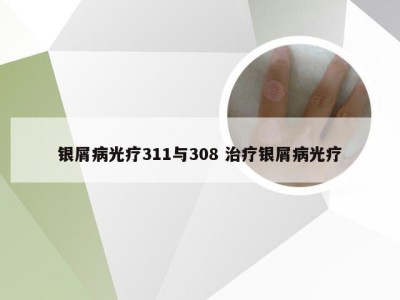 银屑病光疗311与308 治疗银屑病光疗