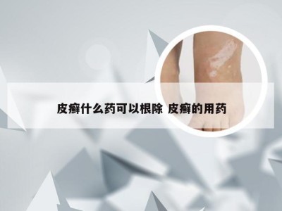 皮癣什么药可以根除 皮癣的用药