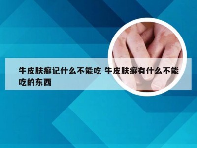 牛皮肤癣记什么不能吃 牛皮肤癣有什么不能吃的东西