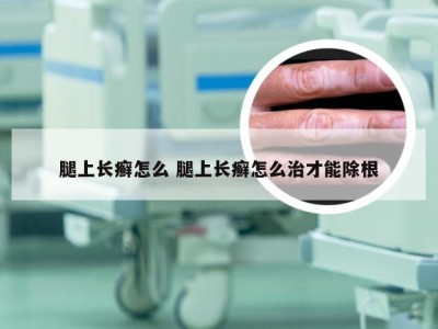 腿上长癣怎么 腿上长癣怎么治才能除根