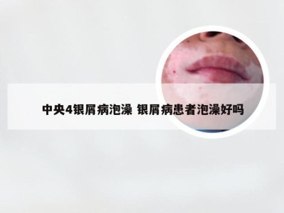 中央4银屑病泡澡 银屑病患者泡澡好吗