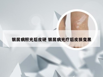 银屑病照光后皮硬 银屑病光疗后皮损变黑