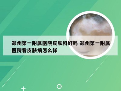 郑州第一附属医院皮肤科好吗 郑州第一附属医院看皮肤病怎么样