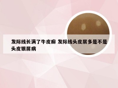 发际线长满了牛皮癣 发际线头皮屑多是不是头皮银屑病