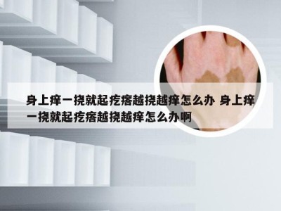 身上痒一挠就起疙瘩越挠越痒怎么办 身上痒一挠就起疙瘩越挠越痒怎么办啊