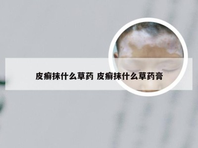 皮癣抹什么草药 皮癣抹什么草药膏