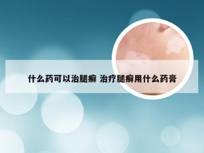 什么药可以治腿癣 治疗腿癣用什么药膏