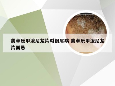 美卓乐甲泼尼龙片对银屑病 美卓乐甲泼尼龙片禁忌