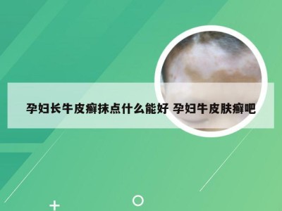 孕妇长牛皮癣抹点什么能好 孕妇牛皮肤癣吧