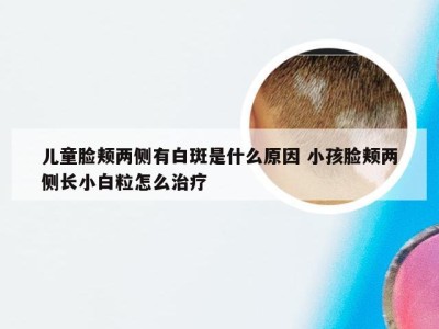 儿童脸颊两侧有白斑是什么原因 小孩脸颊两侧长小白粒怎么治疗