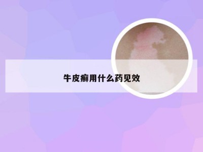 牛皮癣用什么药见效