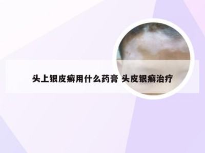 头上银皮癣用什么药膏 头皮银癣治疗