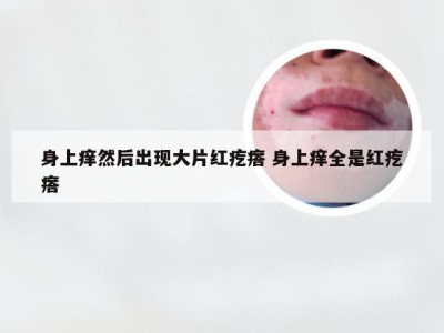 身上痒然后出现大片红疙瘩 身上痒全是红疙瘩